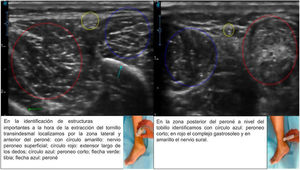 Identificación mediante ecografía de estructuras neurovasculares y ligamentosas. En la identificación de estructuras importantes a la hora de la extracción del tornillo transindesmal localizamos, por la zona lateral y anterior del peroné, con círculo amarillo: nervio peroneo superficial; círculo rojo: extensor largo de los dedos; círculo azul: peroneo corto; flecha verde: tibia; flecha azul: peroné. En la zona posterior del peroné a nivel del tobillo identificamos con círculo azul: peroneo corto; en rojo, el complejo gastrosoleo, y en amarillo, el nervio sural.