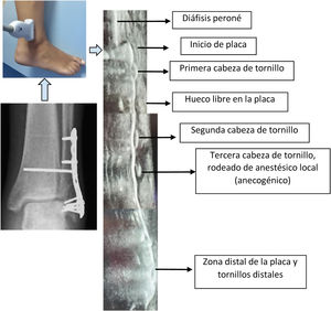 Imagen ecográfica detallada correspondiente a la comparativa entre la radiografía convencional y las imágenes obtenidas con visualización ecográfica en plano longitudinal al eje diafisario y de la placa de osteosíntesis.