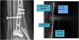 Anatomía ecográfica comparada con radiografía. Observamos en la imagen ecográfica, tomada en plano longitudinal, la extracción de tornillo transindesmal, apreciándose la cabeza del tornillo y la arandela, además de la característica «cola de cometa» producida por los objetos metálicos.