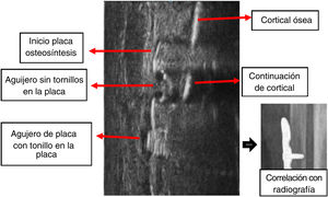 Imagen en «cola de cometa» obtenida con la ecografía: en la zona de la placa con agujero sin tonillo se observa la continuación de la cortical del hueso tratado con placa de osteosíntesis; a ambos lados de ella se aprecia el artefacto producido por el metal en forma de «cola de cometa» que oculta la cortical ósea en la zona de la placa sin agujeros y su correlación con la radiografía simple.
