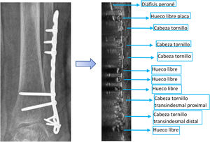 Comparativa entre la radiografía convencional y ecografía en plano longitudinal al eje diafisario. Nótese en los agujeros de la placa sin tornillos la anecogenicidad por no existir el efecto «cola de cometa» que sí desprende el resto de la placa y los agujeros ocupados con tornillos.
