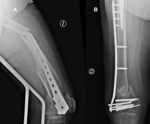 Ejemplos de fracasos del material: Fractura periimplante (A). Fracaso de tornillos de bloqueo a la placa (B).