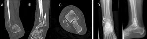 Ejemplo de fractura-avulsión infrasindesmal SAD I tratada mediante placa gancho. A, B, C: TC preoperatoria: fractura-avulsión de peroné distal. D: Radiografía postoperatoria mostrando placa gancho con tornillo interfragmentario de compresión.