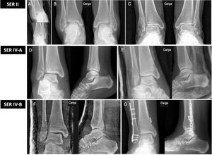 Ejemplo de fractura SER II. A: Radiografía sin carga mostrando fractura bilateral transindesmal de peroné. B: Radiografía en carga con ECM mantenido (<4mm). Se trató mediante carga inmediata sin inmovilización. C: Radiografía en carga a los 6 meses observando correcta consolidación de la fractura. Ejemplo de fractura SER IV A. D: Radiografía en descarga con aumento del ECM (>4mm). E: Radiografía en carga donde se observa reducción del espacio claro medial con la carga a 90°. La fractura se manejó de forma conservadora con un yeso de carga. Ejemplo de fractura de tobillo SER IV B. F: Radiografía en carga, donde se objetiva apertura del ECM y asimetría de la mortaja (lesión inestable). G: Se indica cirugía realizando reducción abierta y fijación interna con placa y tornillos en peroné y fijación de la sindesmosis mediante sistema dinámico.