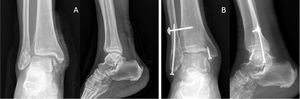 A y B: Ejemplo de fractura transindesmal de peroné tratada mediante tornillo endomedular 3,5mm y tornillo fijando la sindesmosis.