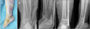 Ejemplo de fractura peroné tratada con clavo endomedular de segunda generación por afectación de partes blandas. A: imagen clínica mostrando lesión severa de partes blandas (herida por fractura abierta). B: Radiografías preoperatorias mostrando fractura bifocal de peroné. C: Radiografías postoperatorias mostrando fijación con clavo de segunda generación y fijación transindesmal con 2 tornillos a través del clavo.