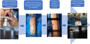 Procedural sequence in ultrasound-guided removal of osteosynthesis hardware: tibial screw dynamisation.