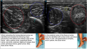 Identification by ultrasound of neurovascular and ligamentous structures. When extracting the transyndesmal screw we identified and located the following major structures in the lateral and anterior area of the fibula: with a yellow circle: superficial fibular nerve; red circle: extensor digitorum longus; blue circle: peroneus brevis; green arrow: tibia; blue arrow: fibula. In the posterior area of the fibula at ankle level we identified with a blue circle: peroneus brevis; in red: the gastrosoleus complex, and in yellow, the sural nerve.