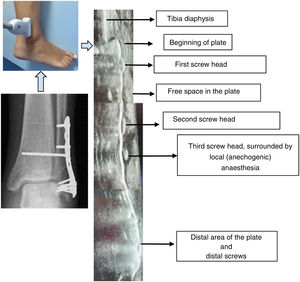 Detailed ultrasound image corresponding to the comparison between conventional radiography and images obtained with ultrasound visualisation in the longitudinal plane of the diaphyseal axis and the osteosynthesis plate.