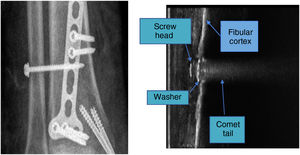 Ultrasound anatomy compared to radiography. In the ultrasound image, taken in a longitudinal plane, we observed the extraction of the transyndesmal screw, showing the screw head and the washer, in addition to the characteristic “comet tail” produced by the metal objects.