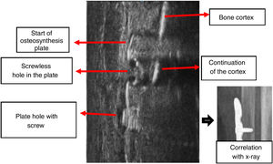 “Comet tail” image obtained with ultrasound: in the area of the plate with a screwless hole, the continuation of the bone cortex treated with the osteosynthesis plate is observed; On both sides of it the artefact produced by the metal in the shape of a “comet tail” which obscures the bone cortex in the area of the plate without holes can be seen, together with its correlation with the simple X-ray.