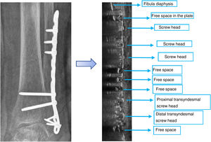 Comparison between conventional radiography and ultrasound in the longitudinal plane to the diaphyseal axis. Note the anechogenicity in the screwless plate holes because there is no “comet tail” effect that the rest of the plate and the holes with screws make.