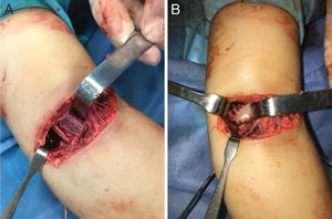 Imágenes quirúrgicas de abordaje anterior de húmero supracondíleo. A) Exposición del haz neurovascular anterior. B) Exposición de la fractura.