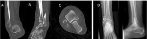 Example of SAD-1 infrasyndesmotic avulsion fracture treated by hooked plate. (A–C) Preoperative CT scan: distal fibula avulsion fracture. (D) Postoperative X-ray showing hooked plate with compression lag screw.
