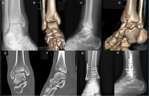 (A–D) Example of transverse fracture of the infrasyndesmotic fibula SAD-2 with vertical line in the internal column. (E and F) CT image showing medial impaction and articular cartilage collapse. (G and H) Postoperative X-rays showing osteosynthesis using anatomical fibula plate, anti-glide plate in internal column, K-wire, and lag screw to restore the articular surface.