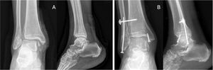 (A and B) Example of a trans-syndesmotic fibular fracture treated with 3.5mm intramedullary screw and screw fixing the syndesmosis.