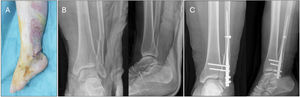 Example of a fibular fracture treated with a second-generation intramedullary nail due to soft tissue involvement. (A) Clinical image showing severe soft tissue injury (open fracture wound). (B) Preoperative X-rays showing bifocal fibula fracture. (C) Postoperative X-rays showing second generation nail fixation and trans-syndesmotic fixation with 2 screws through the nail.