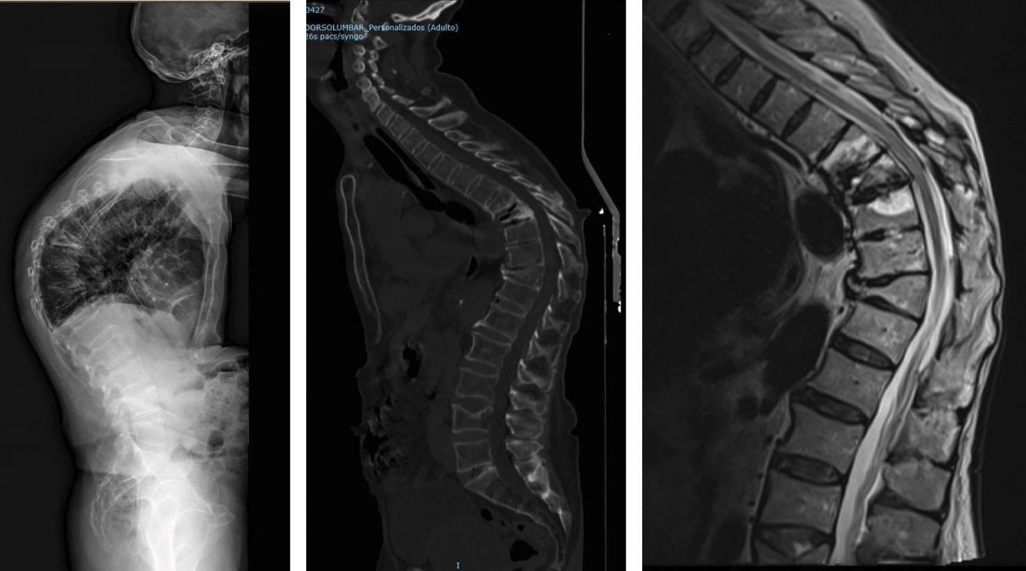 Telerex Protection Factores anatómicos y biomecánicos de la fractura vertebral ...