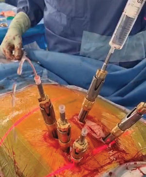 Exemplary illustration of pulsed jet lavage in a bisegmental percutaneous cement augmented dorsal fixation: 0.9% sodium chloride solution is flushed through the vertebral body using a 20ml syringe and exits on the contralateral side. This results in a washout of the vertebra