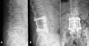 Vertebral body replacement L4. (A) Pathological L4 fracture due to metastatic bronchial carcinoma. (B) Lateral X-ray following short segment fixation with cement augmented pedicle screws and VBR with endplate cementation. (C) Anteroposterior view.