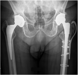 Anteroposterior radiographic view of a revision stem with greater trochanter fracture submitted to plate and screws osteosynthesis.
