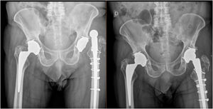 Anteroposterior radiographic view of a dislocated revision stem with greater trochanter fracture and subsequent closed reduction.