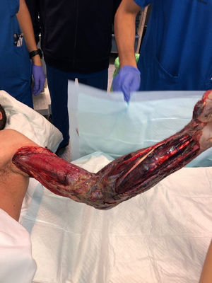 Radical debridement.