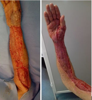 Skin graft coverage.
