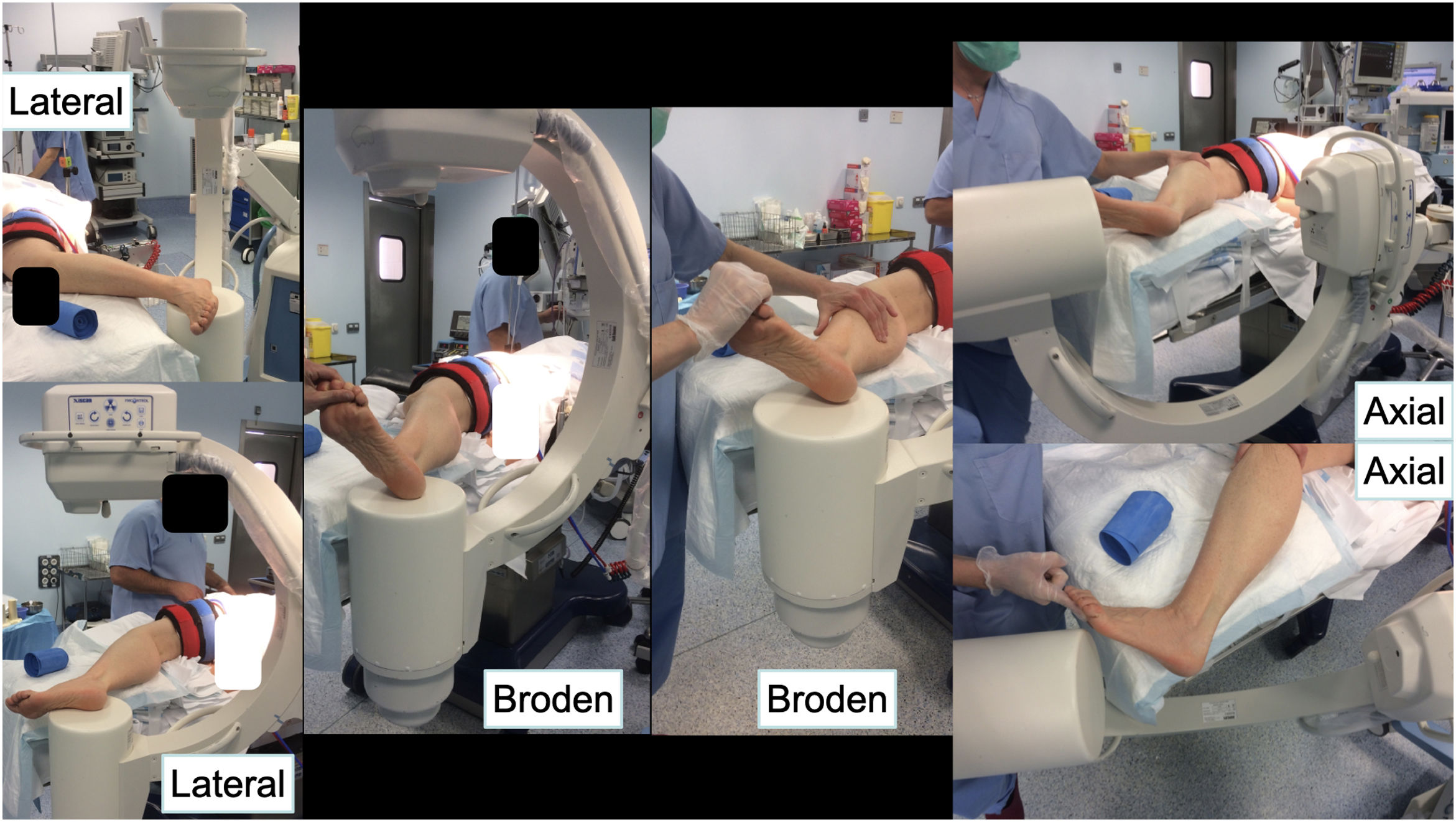Broden Method Técnica quirúrgica del manejo de las fracturas de calcáneo a través de ...