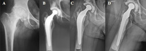 Paciente masculino de 46años con coxartrosis circunferencial. A)Radiografía AP preoperatoria. B)Reemplazo total cementado, control postoperatorio inmediato. C-D)Proyección anteroposterior y lateral tras 14años de seguimiento, sin signos de aflojamiento.
