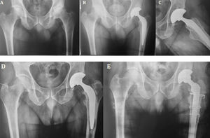 Paciente femenina de 48 años. A)Proyección AP preoperatoria: se observa coxartrosis de cadera izquierda. B-C)Reemplazo total híbrido, control postoperatorio inmediato. D)Control de los 14años: evoluciona con aflojamiento del componente femoral. E)Revisión a vástago de fijación distal con osteotomía femoral extendida.