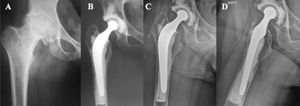 Male patient aged 46 years with circumferential hip osteoarthritis. (A) Preoperative AP X-ray. (B) Total cemented replacement, immediate postoperative control. (C, D) Anteroposterior and lateral projection after 14years of follow-up, with no signs of loosening.