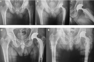 Female patient aged 48years. (A) Preoperative AP projection: left hip osteoarthritis is observed. (B, C) Total hybrid replacement, immediate postoperative control. (D) Control at 14years: evolution with loosening of the femoral component. (E) Revision to distal fixation stem with extended femoral osteotomy.