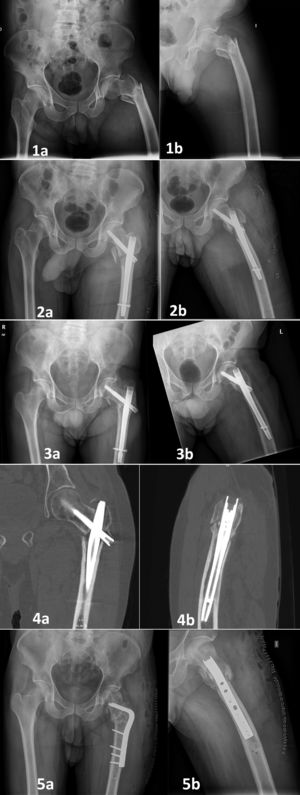 Varón de 65 años con fractura 31.A3.3. Fumador (10cigarrillos/día). Ex-alcohólico. Ex consumidor de drogas. Sin alergias. Infección por VIH, insuficiencia pancreática, cirrosis hepática. Cirugía previa por fractura de clavícula. Desarrolló una consolidación atrófica que requirió osteotomía desrotatoria. Este paciente se halla actualmente bajo seguimiento. 1a)Radiografía anteroposterior en la unidad de urgencias. 1b)Radiografía axial en la unidad de urgencias. 2a)Radiografía anteroposterior el día posterior a la cirugía. 2b)Radiografía axial el día posterior a la cirugía. 3a)Radiografía anteroposterior al año de seguimiento. Pueden observarse varización y no consolidación. 3b)Radiografía axial al año de seguimiento. Pueden observarse varización y no consolidación. 4a)Visión coronal de TC al año de seguimiento, con ausencia de signos de unión. 4b)Visión sagital de TC al año de seguimiento, con ausencia de signos de unión. 5a)Radiografía anteroposterior el día siguiente a la reintervención. 5b)Radiografía axial el día posterior a la reintervención.