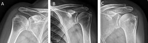Gartner and Heyer classification.6 (A) Type I: well-circumscribed, dense calcification, formative phase. (B) Type II: soft contour/dense or sharp/transparent. (C) Type III: translucent and cloudy appearance without clear circumscription, resorptive phase.