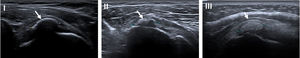 Bianchi and Martinoli classification. Type I: calcifications appear as hyperechoic foci with a well-defined acoustic shadowing due to their substantial quantitative of calcium; Type II: calcification appears as hyperechoic foci with a mild acoustic shadow due to the reduced amount of calcium; Type III: calcification appears almost isoechoic with the tendon, without an acoustic shadow and often they are difficult to diagnose.