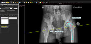 Digital planning using the TraumaCad® software programme. The size of the components is calculated, as well as the femoral offset to correct the dysmetry.