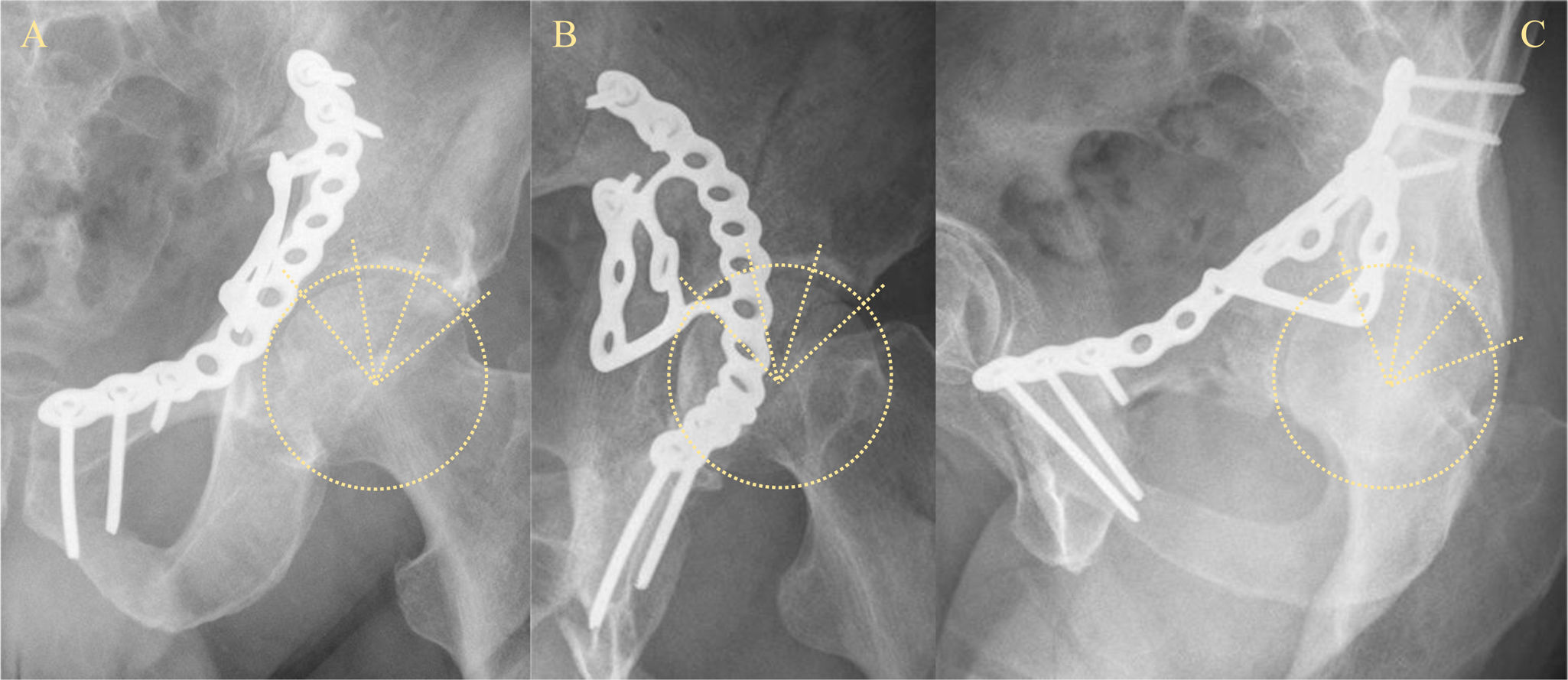 Intrapelvic Intrapelvic suprapectineal acetabular plates interfere with the quality ...