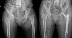 Left pertrochanteric fracture treated with cephalomedullary nailing.