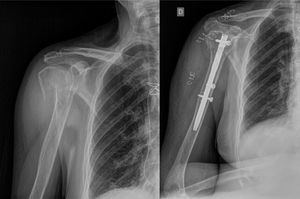 Fracture of the proximal end of the right humerus treated with cephalomedullary nailing.