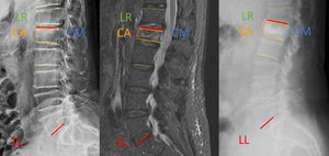 Rx PreQx; MRI PreQx; Rx PostQx: A. PreQx AC height: 7mm; B. PreQx CM height: 13mm; C. PreQx kyphosis: 28.8°. AA. Post-Qx AC height: 13mm; BB. PostQx CM height: 18mm; CC. PostQx kyphosis: 22.9.