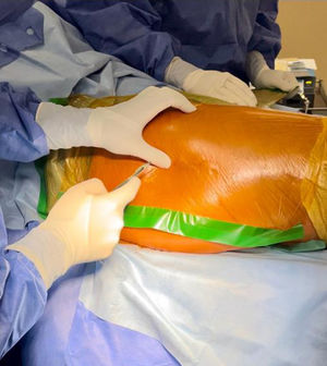 Incision over the adhesive field and skin.