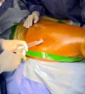 Jamshidi needle inserted into the lateral aspect of the greater trochanter.