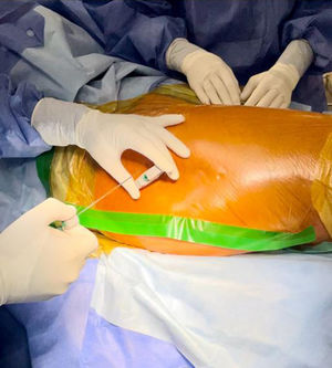 Intraosseous infusion of diluted vancomycin.