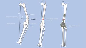 Main steps in the analysis of articular and extra-articular deformities (EAD) and planning of correction with a combined technique (total knee arthroplasty [TKA] with corrective osteotomy [CO]). I. Analysis: determination of the mechanical axis (MA), its deviation (MAD), anatomical axes (AA), joint line convergence angle (JLCA), and apex of the EAD. II. Simulation of extra-articular correction with CO at the apex of the EAD. III. Correction of articular deformity and fixation of osteotomy with the joint implant (TKA).