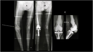 68-Year-old male. (A) Post-fracture osteoarthritis of the right knee. Distal femoral varus extra-articular deformity (EAD) of 24°. Excessive distal femoral resection necessary, invading the insertion of the lateral ligament. Tibial diaphyseal valgus EAD of 4°. (B) Postoperative situation after combined technique (TKA+CO). The slight lateralisation of the MA is due to the tibial EAD, which was considered acceptable. (C) 3.5 years post surgery.