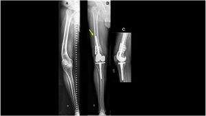 66-Year-old male. (A) Post-osteotomy right knee osteoarthritis. Distal femoral varus EAD of 19°. (B) Correction with combined technique (TKA+CO). Tip effect (arrow) due to selection of too narrow a stem. Fixation augmented with plate.