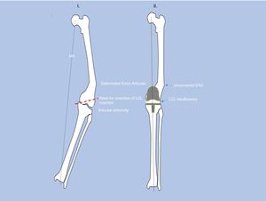 Correction of severe knee osteoarthritis+extra-articular deformity (EAD) by total knee arthroplasty (TKA) alone. Disadvantages compared to the combined technique (TKA+corrective osteotomy). I. Greater bone resection putting previous stability at risk. II. Uncorrected anatomical axes. Greater difficulty or impossibility of using stems in the implant.