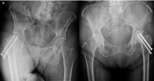 Two CS-synthesis radiographic examples showing avascular necrosis (left) and femoral neck shortening and implant mobilisation (right) are shown.