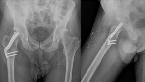 A 52-year-old man with a non-displaced right hip fracture, fixed with the FNS system with two screws in a metaphyseal plate.